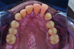 (8.) Retracted frontal, maxillary occlusal, and mandibular occlusal photographs, respectively, acquired after the performance of scaling and root planing and the extraction of teeth Nos. 1, 2, 15, 16, 17, 31, and 32.