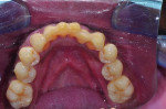 (9.) Retracted frontal, maxillary occlusal, and mandibular occlusal photographs, respectively, acquired after the performance of scaling and root planing and the extraction of teeth Nos. 1, 2, 15, 16, 17, 31, and 32.