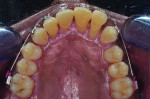 (10.) Progression of the limited orthodontic treatment performed on the maxillary arch to correct tooth No. 7.