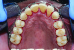 (11.) Progression of the limited orthodontic treatment performed on the maxillary arch to correct tooth No. 7.