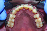 (12.) Progression of the limited orthodontic treatment performed on the maxillary arch to correct tooth No. 7.