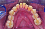 (13.) Occlusal preparation and postoperative views of the mandibular intracoronal splinting and interproximal bonding
utilizing orthodontic braided wire and composite material.