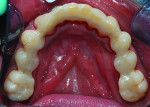 (14.) Occlusal preparation and postoperative views of the mandibular intracoronal splinting and interproximal bonding
utilizing orthodontic braided wire and composite material.