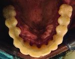 (16.) cclusal preparation and postoperative views of the maxillary intracoronal splinting and interproximal bonding utilizing orthodontic braided wire and composite material.