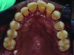 (15.) Occlusal preparation and postoperative views of the maxillary intracoronal splinting and interproximal bonding utilizing orthodontic braided wire and composite material.