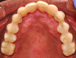 (18.) Four-year postoperative follow-up photographs, including maxillary and mandibular occlusal views, retracted right and left lateral views, a retracted frontal view, and a smile photograph, respectively.