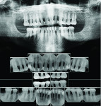 (24.) Four-year postoperative follow-up panoramic and periapical radiographs.