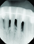 (26.) Comparison of the preoperative
and 4-year follow-up periapical radiographs of the mandibular incisors demonstrating evidence of periapical bone formation.