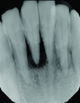 (25.) Comparison of the preoperative
and 4-year follow-up periapical radiographs of the mandibular incisors demonstrating evidence of periapical bone formation.