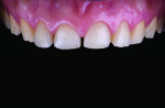 Fig 2. Initial intraoral frontal view
of the maxilla showing attrition on the incisal edges of the maxillary
incisors.