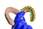 Fig 5. Printed wax-up model (left) and silicone matrix (right) used to transfer the design to the patient.