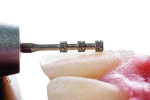 Fig 6. Lateral view of depth cutting diamond
bur used to control thickness of the facial tooth preparation.