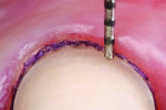 Fig 7. Occlusal view of minimally invasive 0.3-mm preparation at the cervical
margin of tooth No. 8.