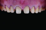 Fig 8. Frontal view of the 360-degree veneer preparations on the maxillary canines, lateral incisors, and central incisors.