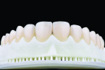 Fig 11. Final restorations fabricated in zirconia-reinforced lithium disilicate on the printed model.