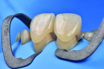 Fig 15. Fit check
of restorations under rubber dam isolation.