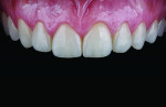 Fig 20. Intraoral frontal view
of maxilla at follow-up appointment 2 weeks post-insertion, showing a natural appearance and
integration.