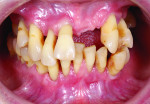 Fig 2. Terminal dentition in the maxillary and mandibular arches.