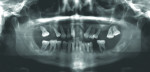 Fig 3. Pretreatment panoramic x-ray.