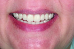 Fig 4. Close-up view of the patient’s smile with immediate dentures post-insertion.