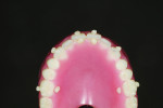 Fig 5. Occlusal view of the denture with radiopaque resin
dots placed to allow for the alignment of the STL files of the denture with the DICOM files.