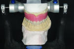 Fig 6. The maxillary denture was mounted to allow
for precise transfer of the vertical dimension and occlusion to the implant design software.