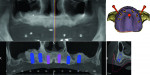 Fig 7. With the resin dot markers on the denture and
the denture in place, a CBCT was taken to allow for the planning of prosthetically driven placement of six implants in the maxilla.