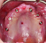 Fig 8. After fully guided placement of six implants in the maxillary arch, straight multi-unit abutments 2 mm in height were placed.