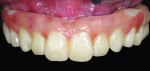 Fig 9. Immediate loading of the 3D-printed screw-retained interim prosthesis immediately postoperative.