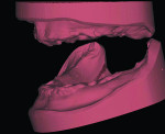 Fig 11 and Fig 12. Master models mounted using the existing screw-retained temporary prosthesis to maintain the existing vertical dimension. Fig 11: Edentulous maxilla and mandible mounted and ready for design of the
prosthesis. Fig 12: The temporary restorations were scanned and used to allow for mounting of the edentulous master models without the need
for traditional analog wax rims and re-establishment of a new vertical dimension.