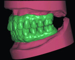 Fig 11 and Fig 12. Master models mounted using the existing screw-retained temporary prosthesis to maintain the existing vertical dimension. Fig 11: Edentulous maxilla and mandible mounted and ready for design of the
prosthesis. Fig 12: The temporary restorations were scanned and used to allow for mounting of the edentulous master models without the need
for traditional analog wax rims and re-establishment of a new vertical dimension.