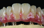 Fig 15. 3D-printed maxillary prosthesis during the microstaining and soft-tissue buildup process.