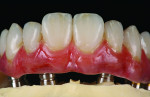 Fig 16. 3D-printed maxillary prosthesis finalized after microstaining was applied on the gingival portions and dental structures to achieve optimal esthetics.