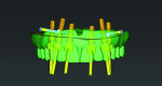 Fig 1. Surgical plan of six maxillary one-piece implants distributed between the maxillary sinuses.