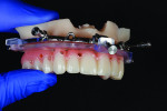 Fig 2. The guided system used in this workflow
consists of a metallic bone reduction guide, stackable guides, and a milled PMMA provisional.