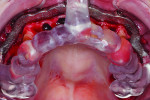 Fig 3. The bone reduction guide is screwed to the maxillae using the occlusal indexing guide to assure precise placement.