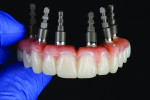 Fig 6. The XD scan sequence of the immediate provisional
restoration begins by scanning analogs screwed into the provisional restoration.