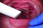 Fig 7. Intraoral scanning of the soft tissues is also carried out.