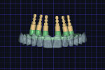 Fig 9. The definitive prosthesis is designed with appropriate prosthetic space due to the previous bone reduction.