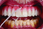 Fig 14. The definitive hybrid prosthesis at 6-month follow-up; note the cleansable design.