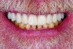 Fig 15. Patient’s smile at 6-month follow-up displaying optimal esthetics.