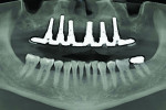 Fig 16. Panoramic radiograph at 6-month follow-up.