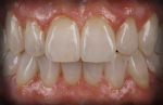 Fig 18. Final FP3 zirconia restorations post-insertion.