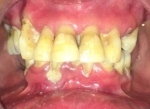 Fig 1. Erythematous plaque having a glazed surface was present on the lower lip along with intraoral, generalized gingival erythema.