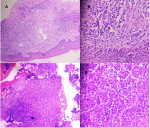 Fig 2. Histopathological study of the gingiva (upper two images) showed the presence of plasma cell: (A, upper left) H&E stain 100X; (B, upper right) H&E stain 400X. Histopathological study of the lip (lower two images) showed the presence of plasma cell: (C, lower left) H&E stain 100X; (D, lower right) H&E stain 400X.