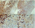 Fig 3. Immunohistochemical study: (A, upper left) The plasma cells in the gingiva expressed positivity for kappa expression (100X). (B, upper right) The plasma cells in the gingiva expressed positivity for lambda expression (100X). (C, lower left) The plasma cells in the site of the lip expressed positivity for lambda expression (400X). (D, lower right) The plasma cells in the site of the lip expressed positivity for kappa expression (400X).