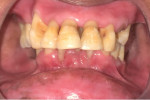 Fig 4. Marked clinical improvement of symptoms was noted after 3 weeks.