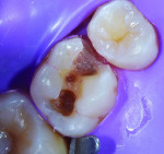 (3.) A caries indicator was used to disclose the location of any remaining infected pulpal caries.