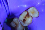 (2). View of the preparation following removal of the old composite and initial removal of the carious dentin.