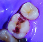 (4.) Occlusal view of the preparation following complete caries removal and verification using the caries indicator. Note that any remaining staining is from affected dentin not infected dentin.